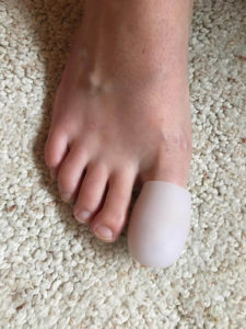 Hammer Toe Treatment Kit photo review